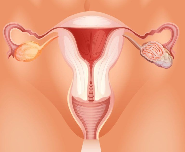 Ovarian tumor in woman illustration
