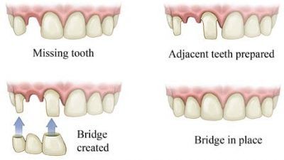 Dental bridge diagram Dental bridge diagram
