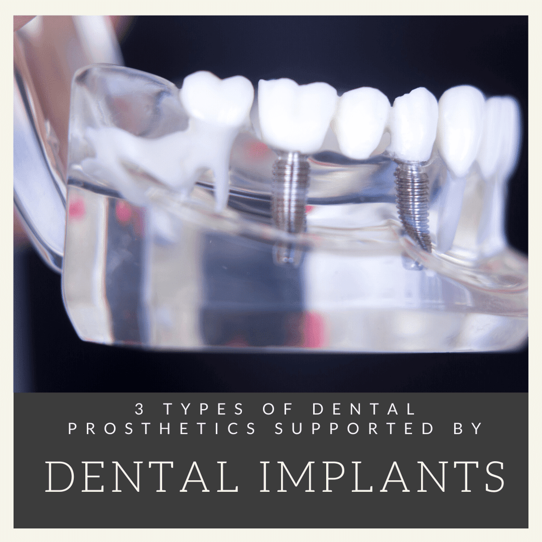 3 Dental Prosthetics Supported by Dental Implants Empire Dental