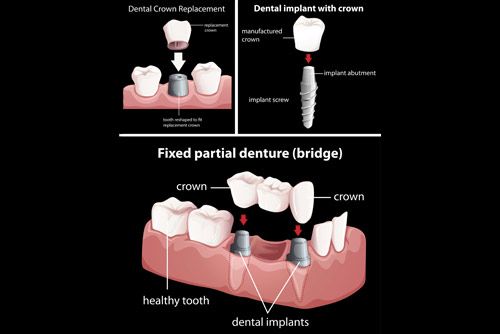 The Top 3 Things You Need to Know About Mini Dental Implants - Advanced