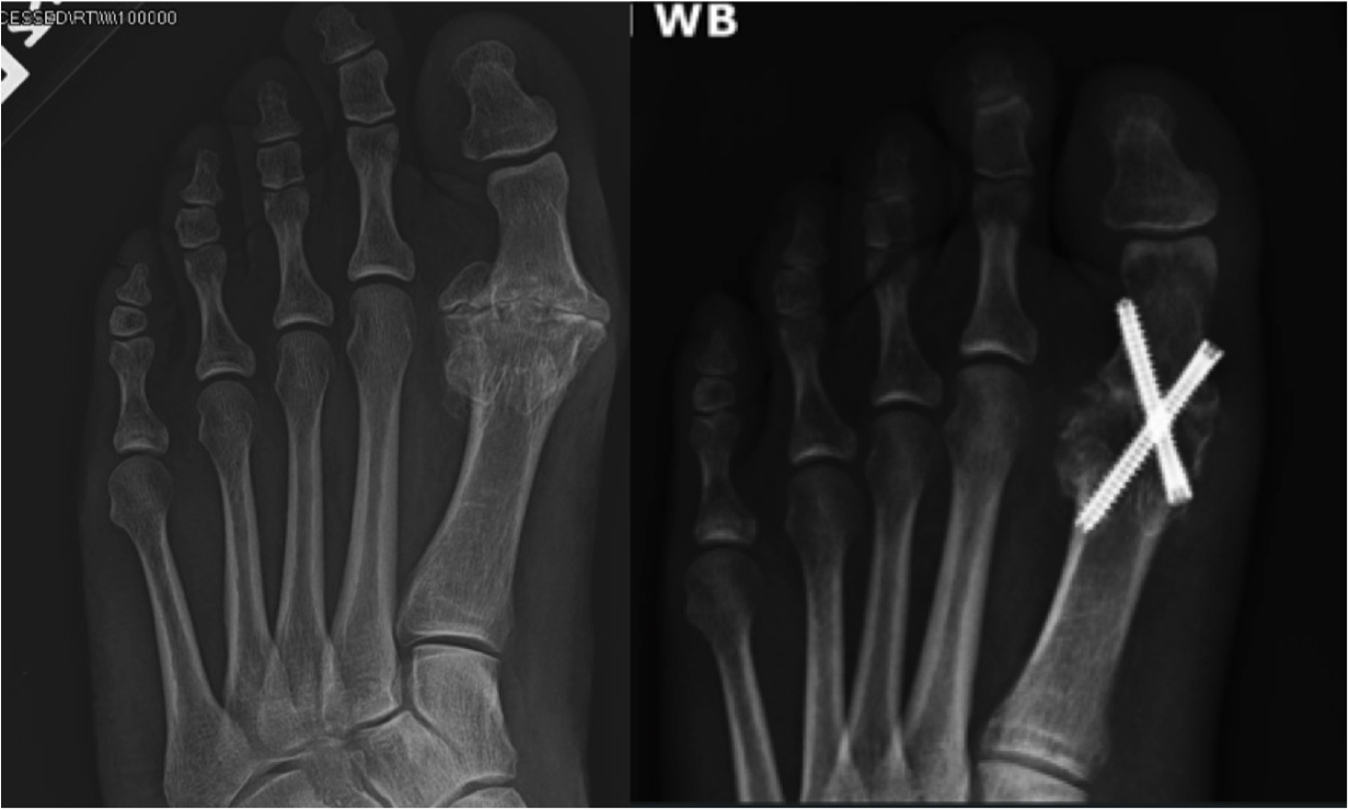 Hallux Rigidus Arthritis of the big toe Christopher Miller