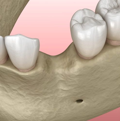 Bone grafts