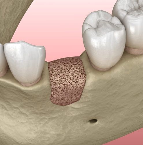 Bone grafts