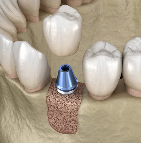 Bone Grafts