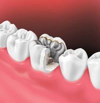 cracked tooth filling