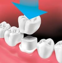 Dental Crown installation