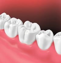 Dental Crown after installation