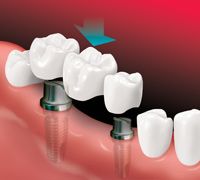 dental crown bridge installation