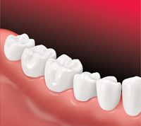 Dental crown bridge installed