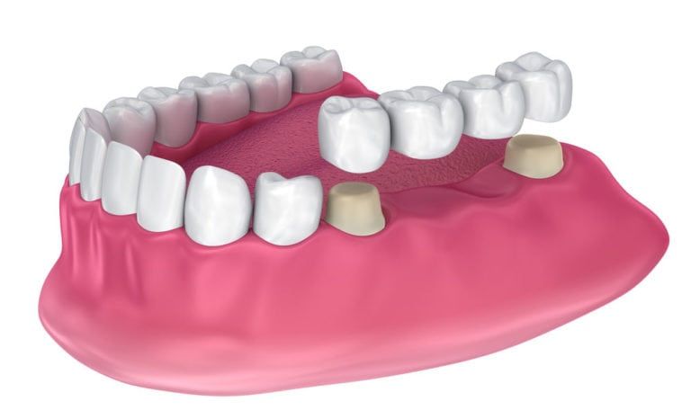 dental bridge installation