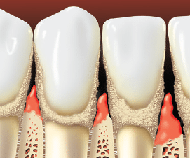 Periodontitis teeth