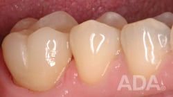 Crown Amalgam recovery