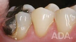 Crown Amalgam in tooth