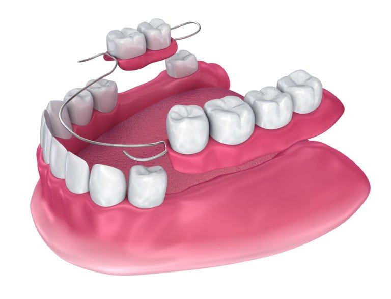 Implant Supported Dentures