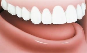 Dentures Implants