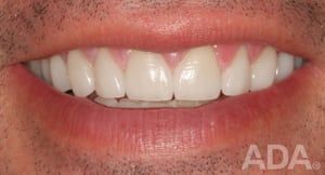 Teeth whitening