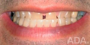 Space in teeth
