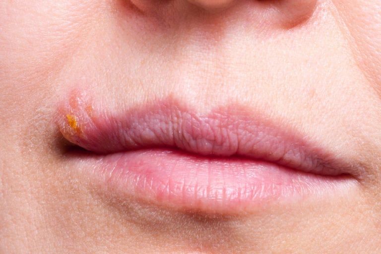 Mouth sores