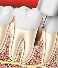 Periodontitis teeth treatment