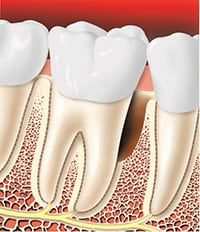 Periodontitis teeth
