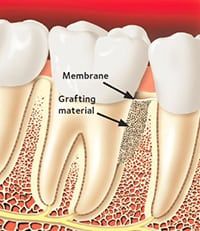 Periodontitis teeth