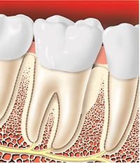 Periodontitis Surgery