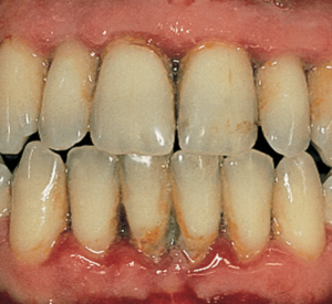 Periodontitis teeth
