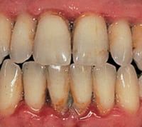 Periodontitis teeth