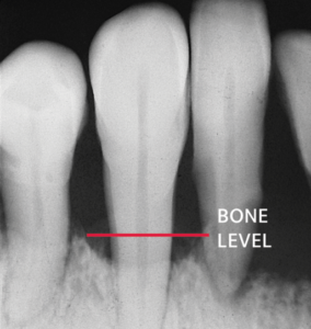 Tooth Radiography