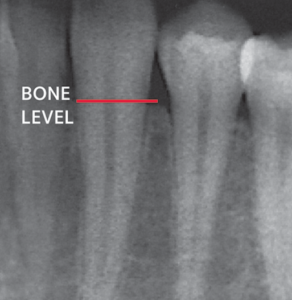 Tooth Radiography