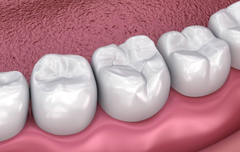 Tooth surface protected by a sealant