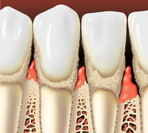 Stages of Periodontal Disease
