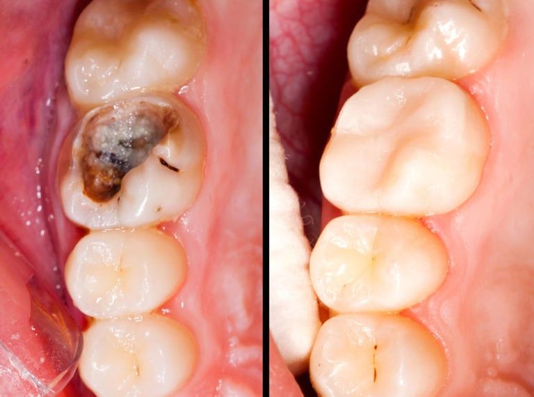 Tooth Decay