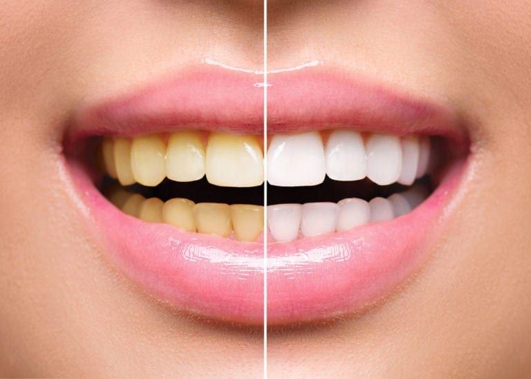 Teeth after whitening