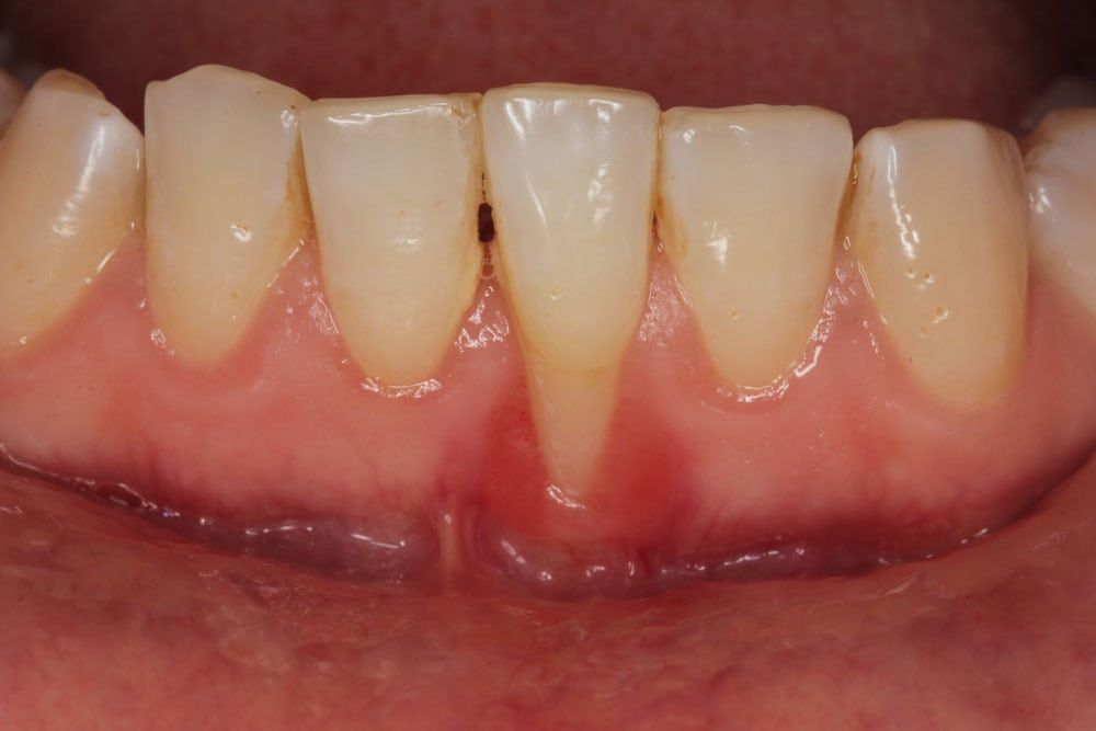 Patient teeth