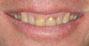 Patient teeth before whitening