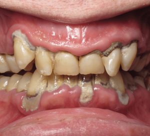 Periodontitis teeth disease