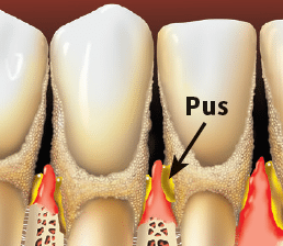 Periodontitis teeth