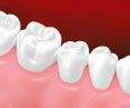 dental bridge tooth installation