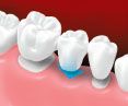 Dental bridge tooth installation