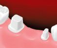 dental bridge prepare image