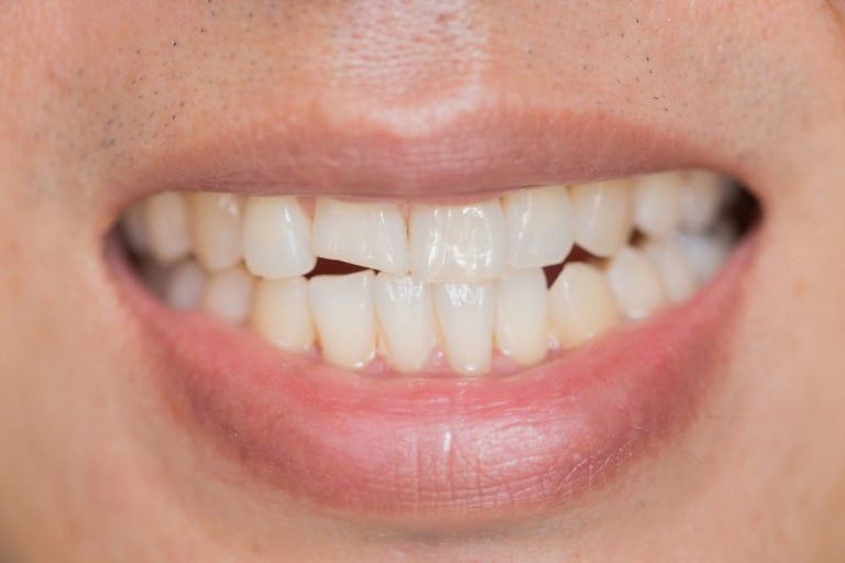 crack in teeth
