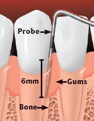 Periodontitis teeth