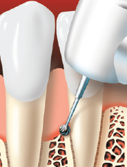 Periodontitis teeth treatment