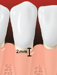 Periodontitis teeth