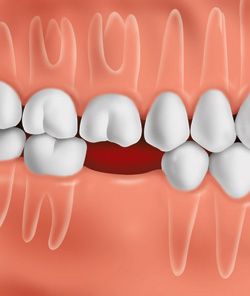 Lost tooth image