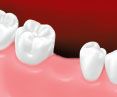 Missing tooth image