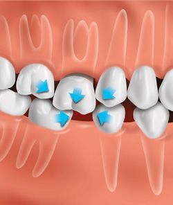 unstructured teeth image
