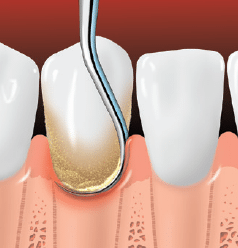 Periodontitis teeth