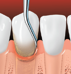 Periodontitis teeth